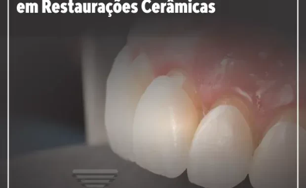 A Importância da Personalização em Restaurações Cerâmicas