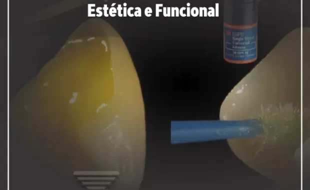 Cimentação: O Ponto Alto da Reabilitação Estética e Funcional