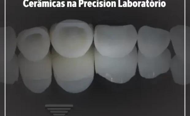 Resultados Excepcionais em Restaurações Cerâmicas na Precision Laboratório